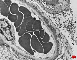 M,60y. | membranous glomerulopathy - st.I M,60y. | membranous glomerulopathy - st.I
